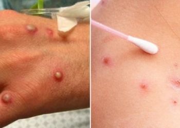 Tres nuevos positivos por viruela del mono en la Comunitat Valenciana; ya son siete los casos confirmados